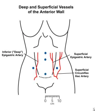 Where are trocars placed in laparoscopy Where are trocars placed in laparoscopy